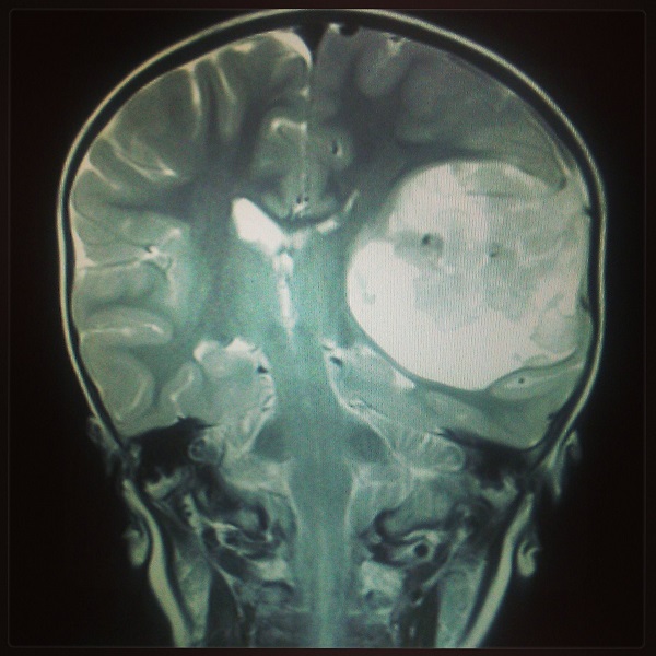 Chase's brain tumor