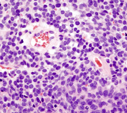 medulloblastoma cells