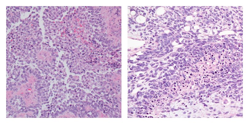 images of classic alveolar rhabdomyosarcoma and embryonal rhabdomyosarcoma