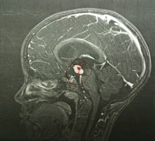 MRI image of Joseph's brain tumor