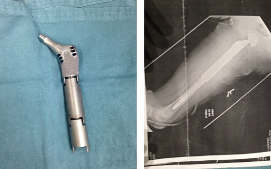 Part of Alyssa's leg implant and Alyssa's xray