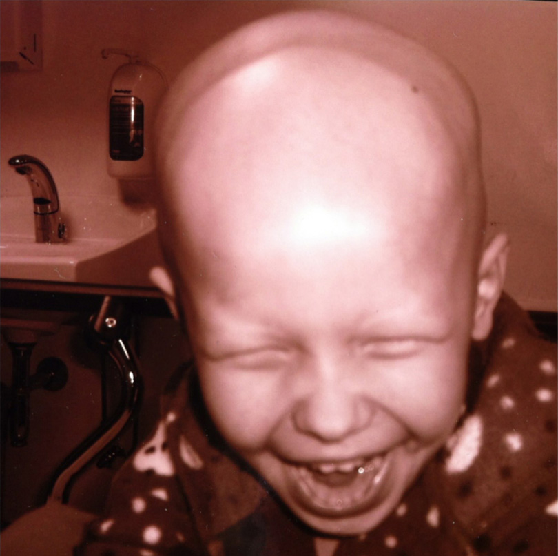Sara laughing with a bald head from her chemo treatments